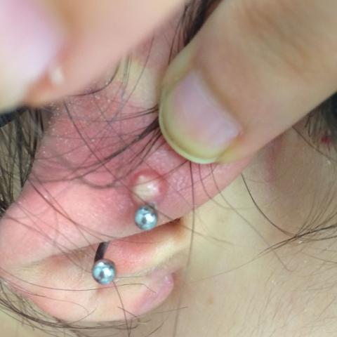 Helix 2
 - (Piercing, Tattoo, Entzündung)