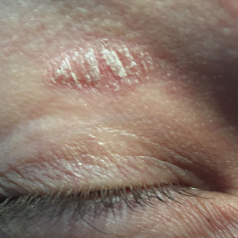 Eine Art Kruste am Augenlid - (Krankheit, Haut, Augen)