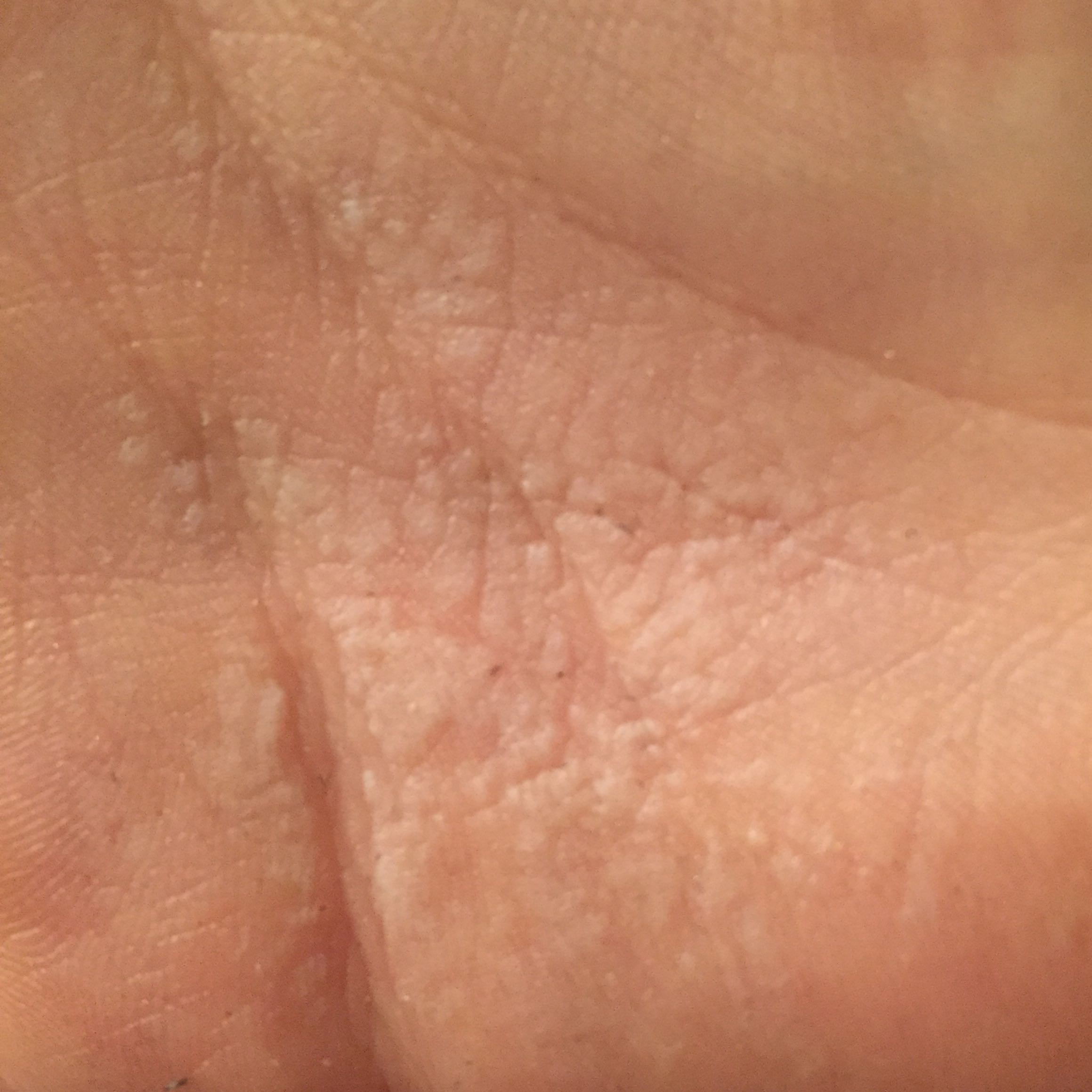 Was ist das? Flecken Hand (Handfläche) Was ist das? Flecken Hand (Handfläche)