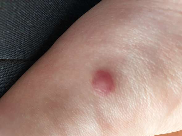 Was Ist Das Fur Don Muckenstich Gesundheit Und Medizin Krankheit Stich