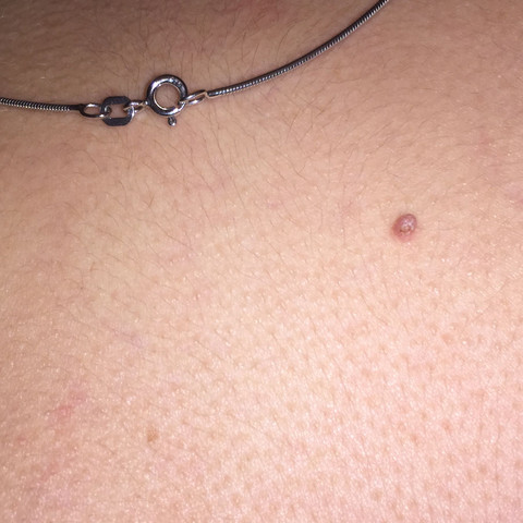 Es ist ungefähr 2-4 mm breit - (Haut, Rücken, Geschwulst)