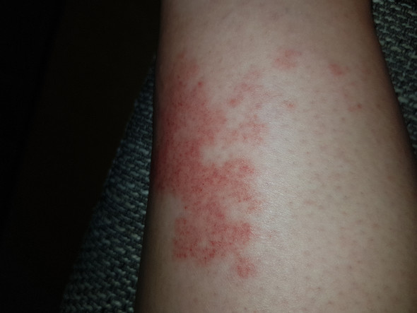 was ist das für ein Ausschlag am bein? (Haut, Hautprobleme) was ist das für ein Ausschlag am bein? (Haut, Hautprobleme)