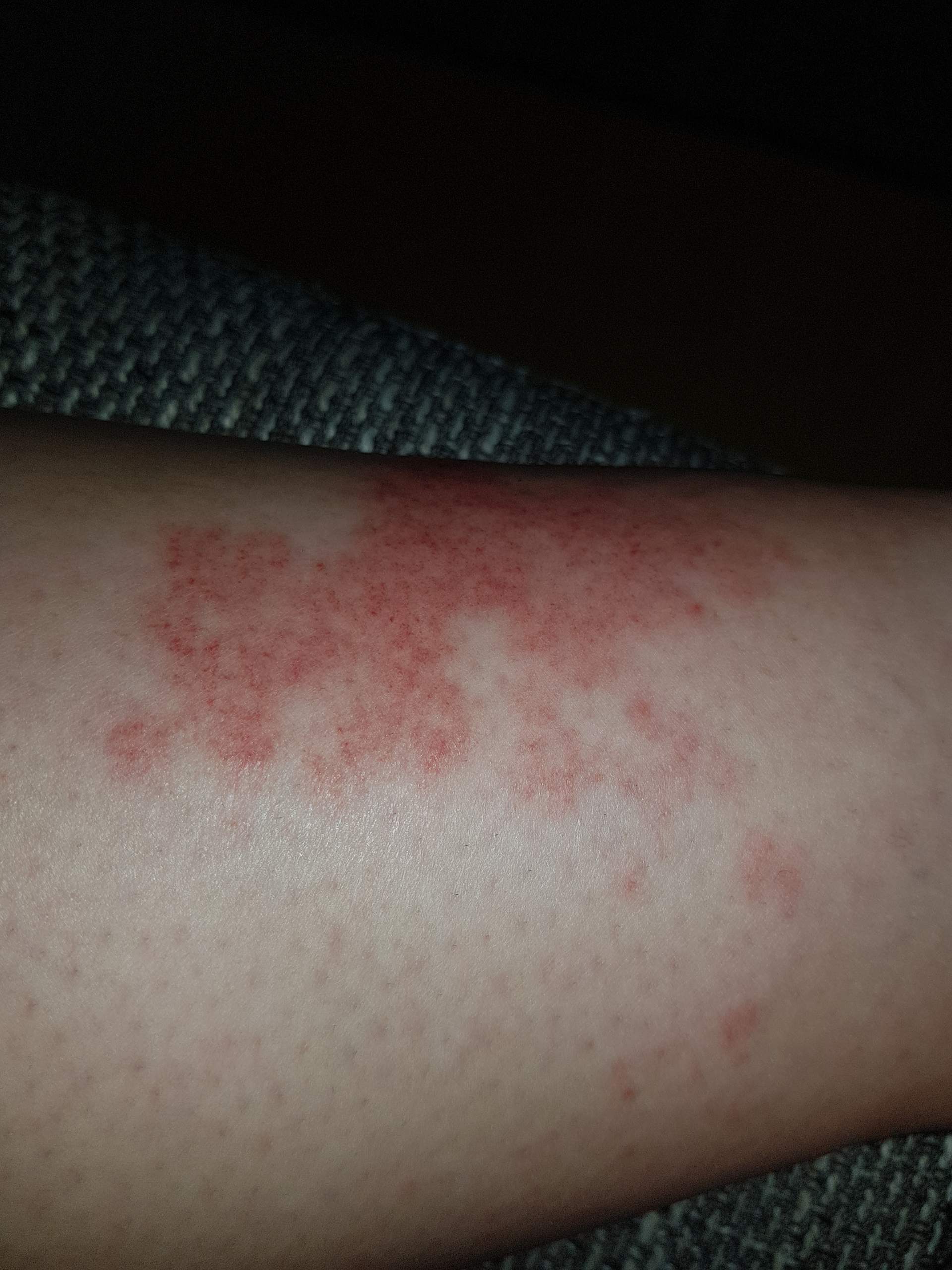 was ist das für ein Ausschlag am bein? (Haut, Hautprobleme)