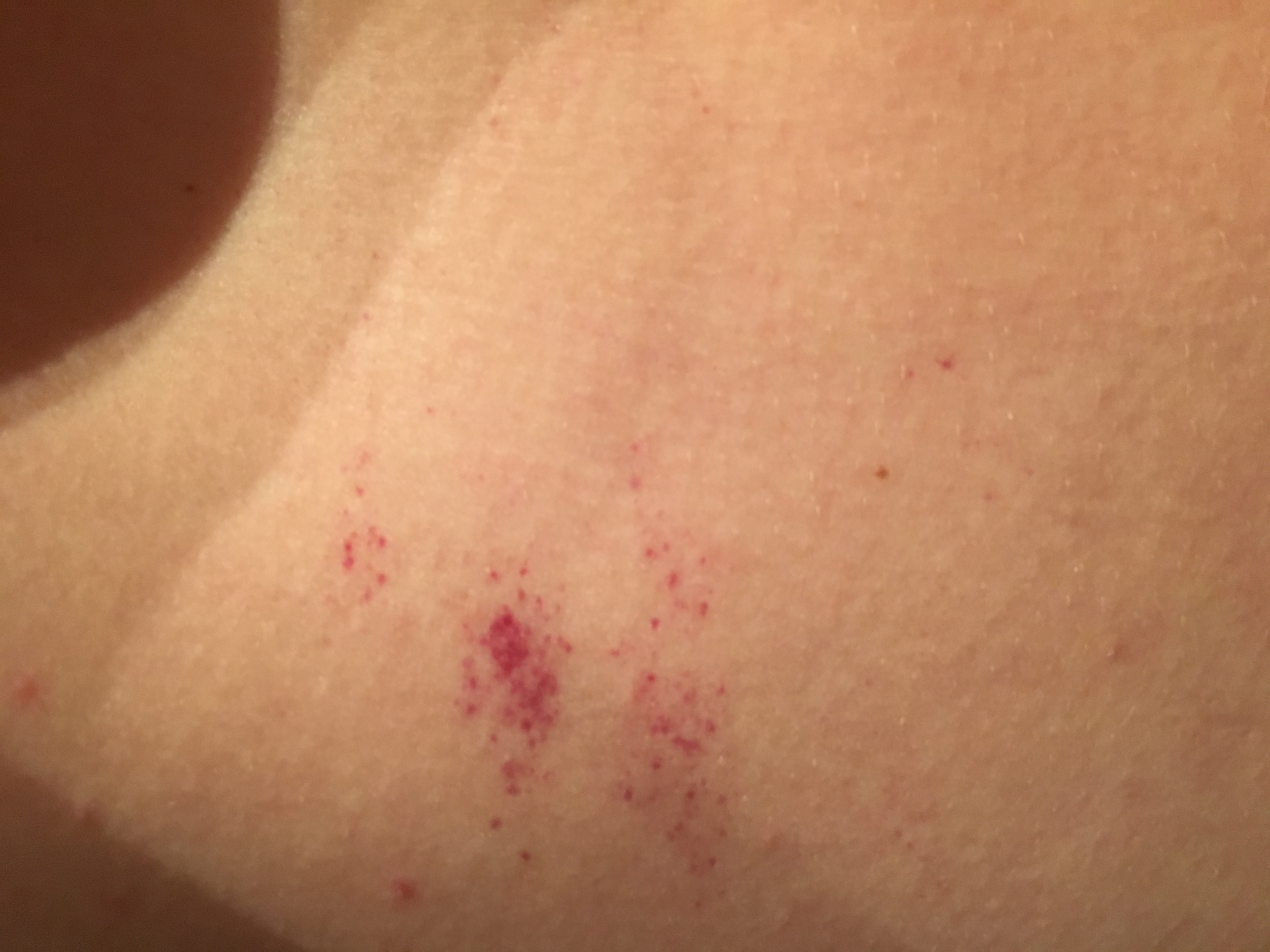 Was ist das für ein Ausschlag an mir? (Hautausschlag)