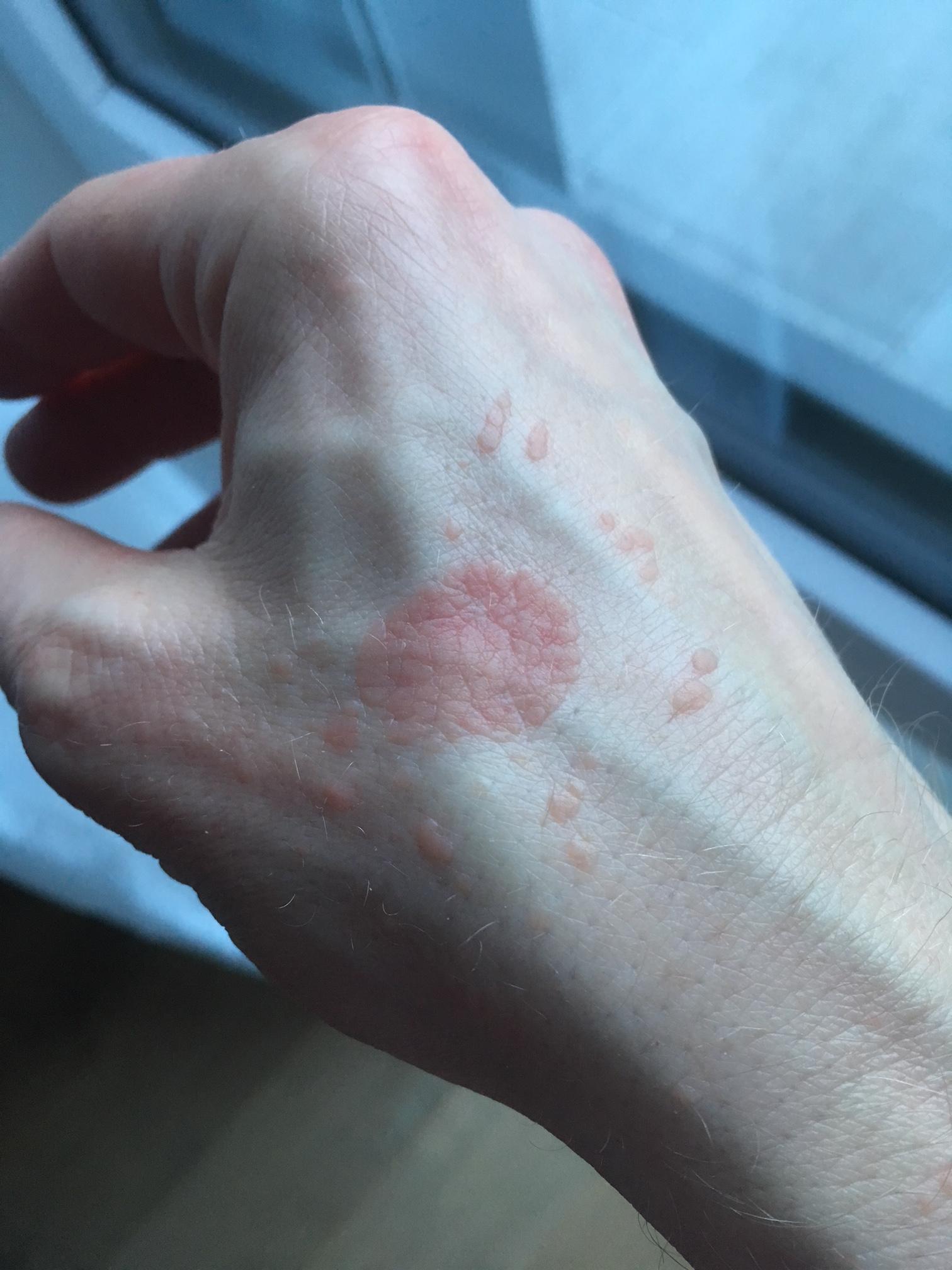 Was ist das für ein "Ausschlag" auf meinem Handrücken? (Hautarzt, Hautprobleme, Hautkrankheit)