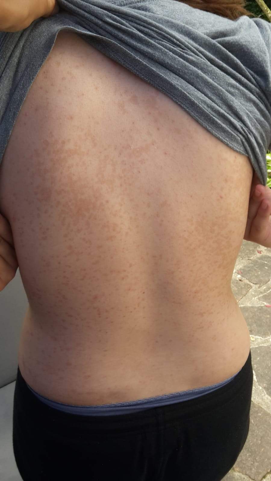 Was Ist Das Fur Ein Ausschlag Auf Meinem Rucken Gesundheit Und Medizin Was Ist Das Fur Ein Ausschlag Auf Meinem Rucken Gesundheit Und Medizin