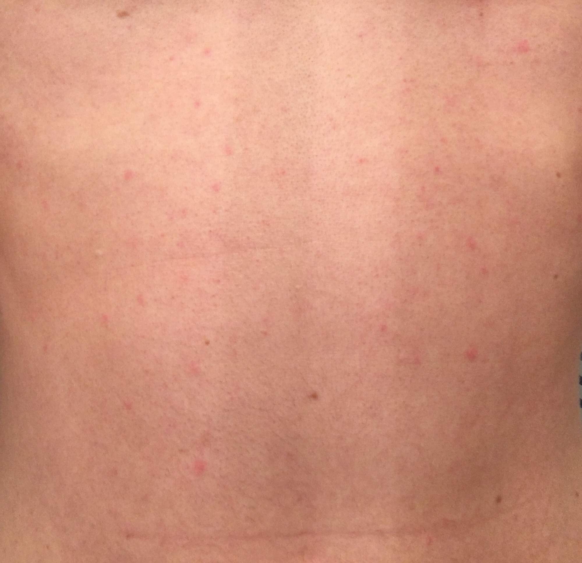 Was ist das für ein Ausschlag (Bauch/Brust)? (Haut, Hautprobleme, Hautausschlag)