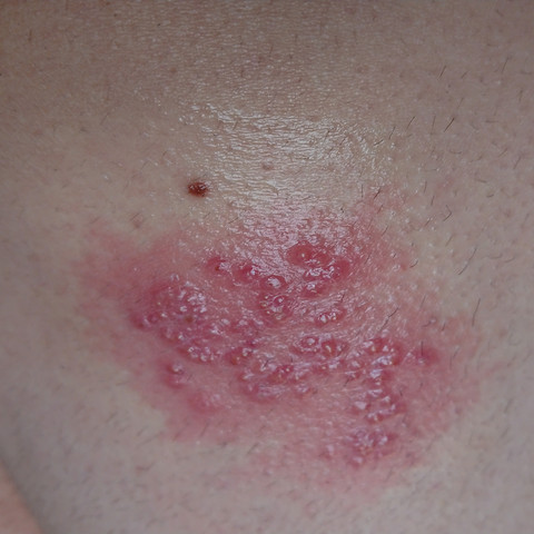 Was Ist Das Fur Ein Ausschlag Bild Welche Salben Helfen Muss Ich Zum Arzt Po Jucken Hufte Was Ist Das Fur Ein Ausschlag Bild Welche Salben Helfen Muss Ich Zum Arzt Po Jucken Hufte