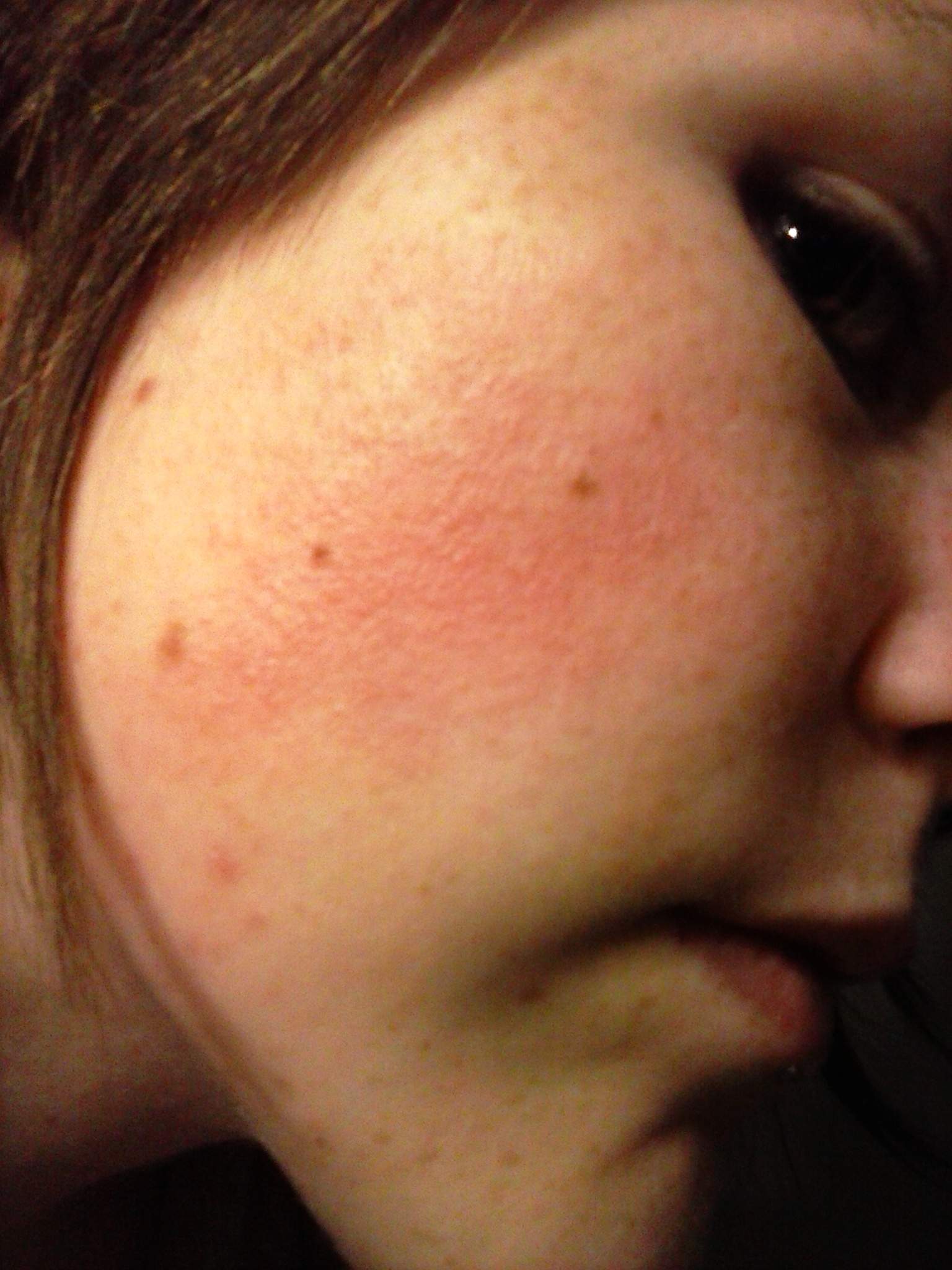 Was Ist Das Fur Ein Ausschlag Feine Blaschen Rotung Medizin Haut Gesicht Was Ist Das Fur Ein Ausschlag Feine Blaschen Rotung Medizin Haut Gesicht