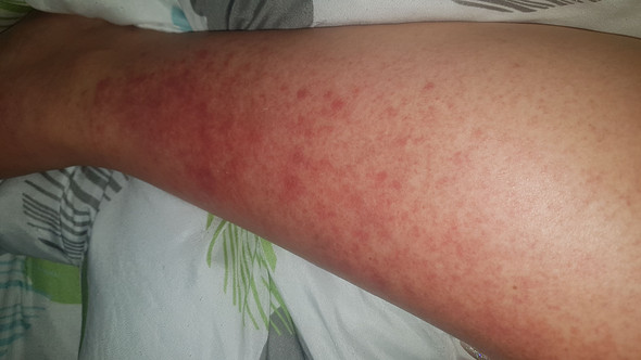 Was Ist Das Fur Ein Ausschlag Nach Der Sonne Gesundheit Und Medizin Gesundheit Medizin Was Ist Das Fur Ein Ausschlag Nach Der Sonne Gesundheit Und Medizin Gesundheit Medizin
