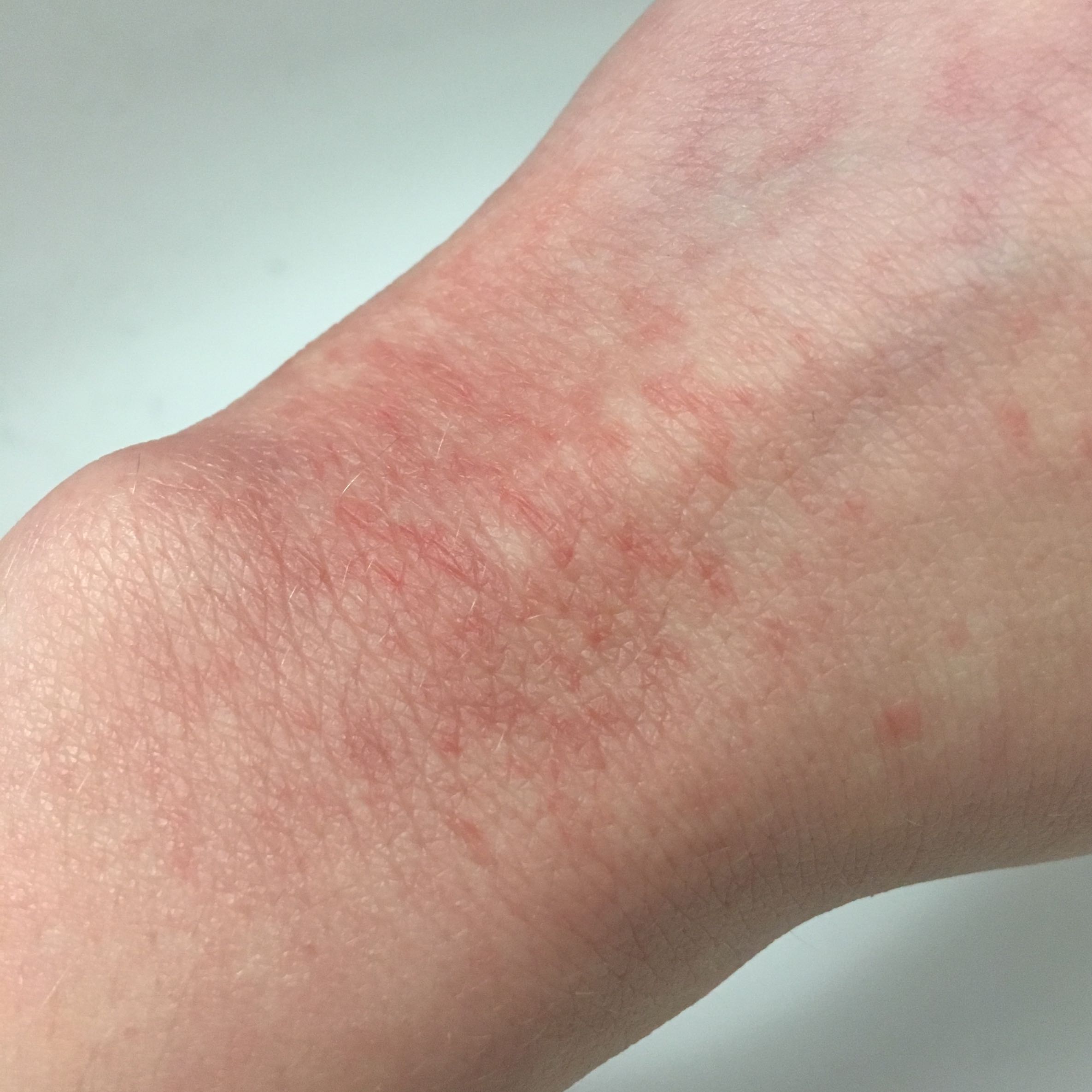 Was ist das für ein Ausschlag (Soll ich zum Hautarzt)? (Gesundheit und Medizin, Haut, Wasser)