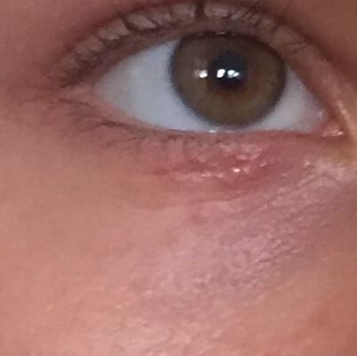 Was Ist Das Fur Ein Ausschlag Unter Dem Auge Haut Augen Blaeschen Was Ist Das Fur Ein Ausschlag Unter Dem Auge Haut Augen Blaeschen
