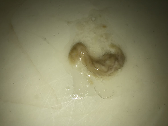 Was Ist Das Fur Ein Auswurf Gesundheit Was Ist Das Fur Ein Auswurf Gesundheit