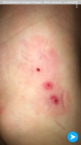 Bettwanzen biss bilder Bettwanzen biss bilder