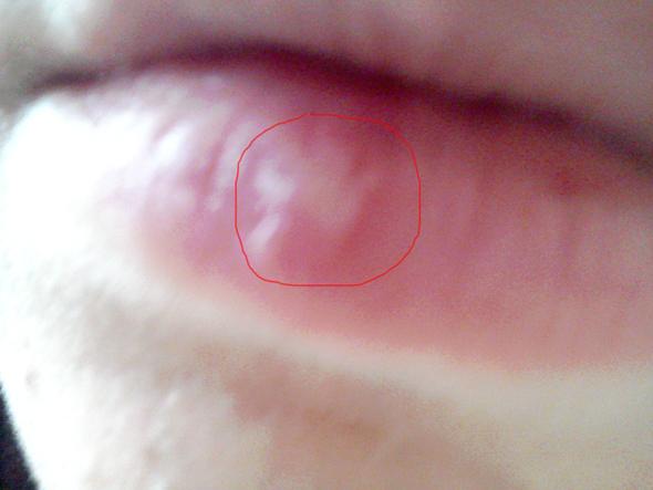 Was Ist Das Fur Ein Blaschen Gesundheit Tipps Lippe Was Ist Das Fur Ein Blaschen Gesundheit Tipps Lippe