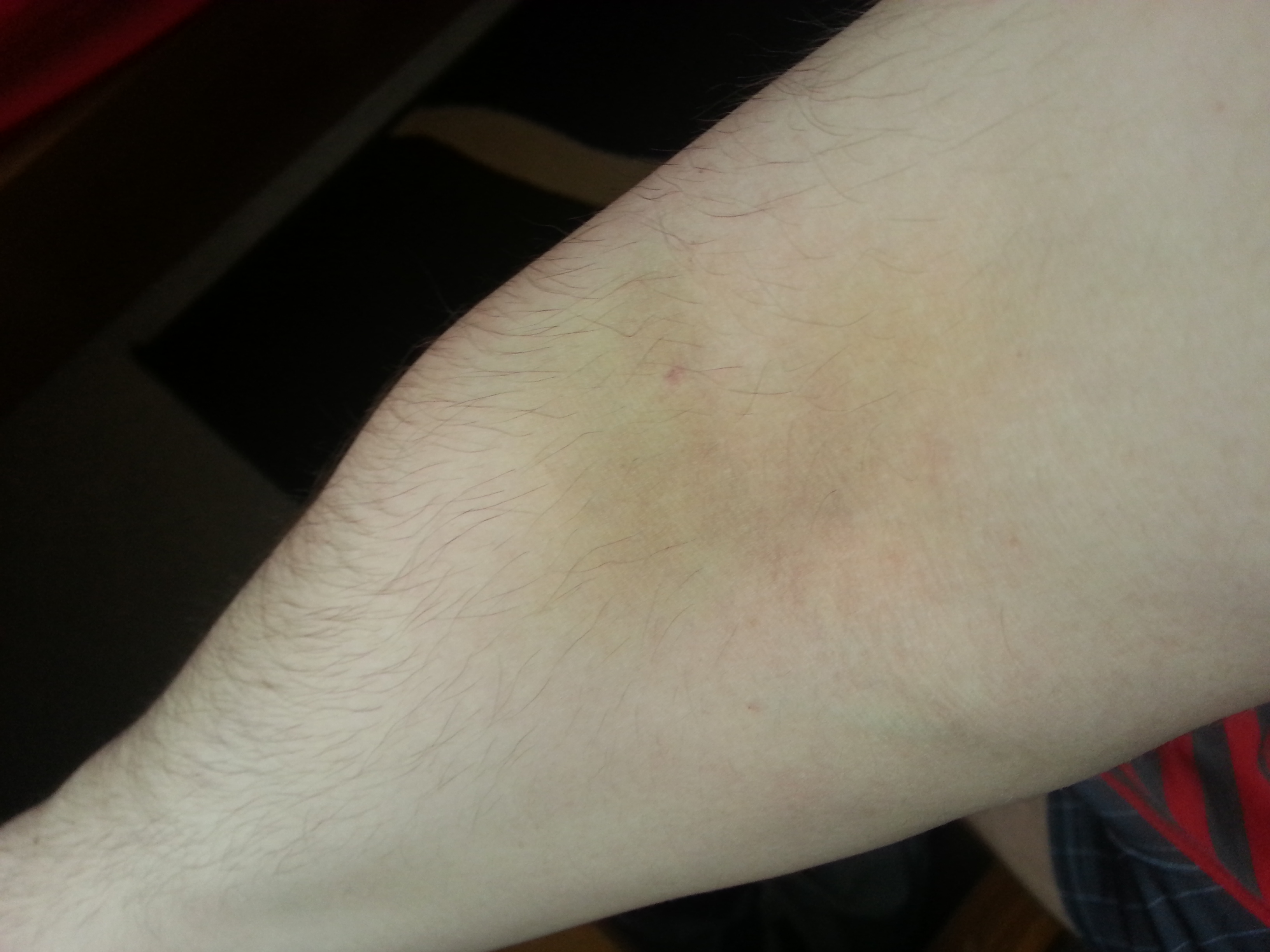 Was ist das für ein blauer Fleck auf meinem Arm? (Gesundheit, Krankheit) Was ist das für ein blauer Fleck auf meinem Arm? (Gesundheit, Krankheit)