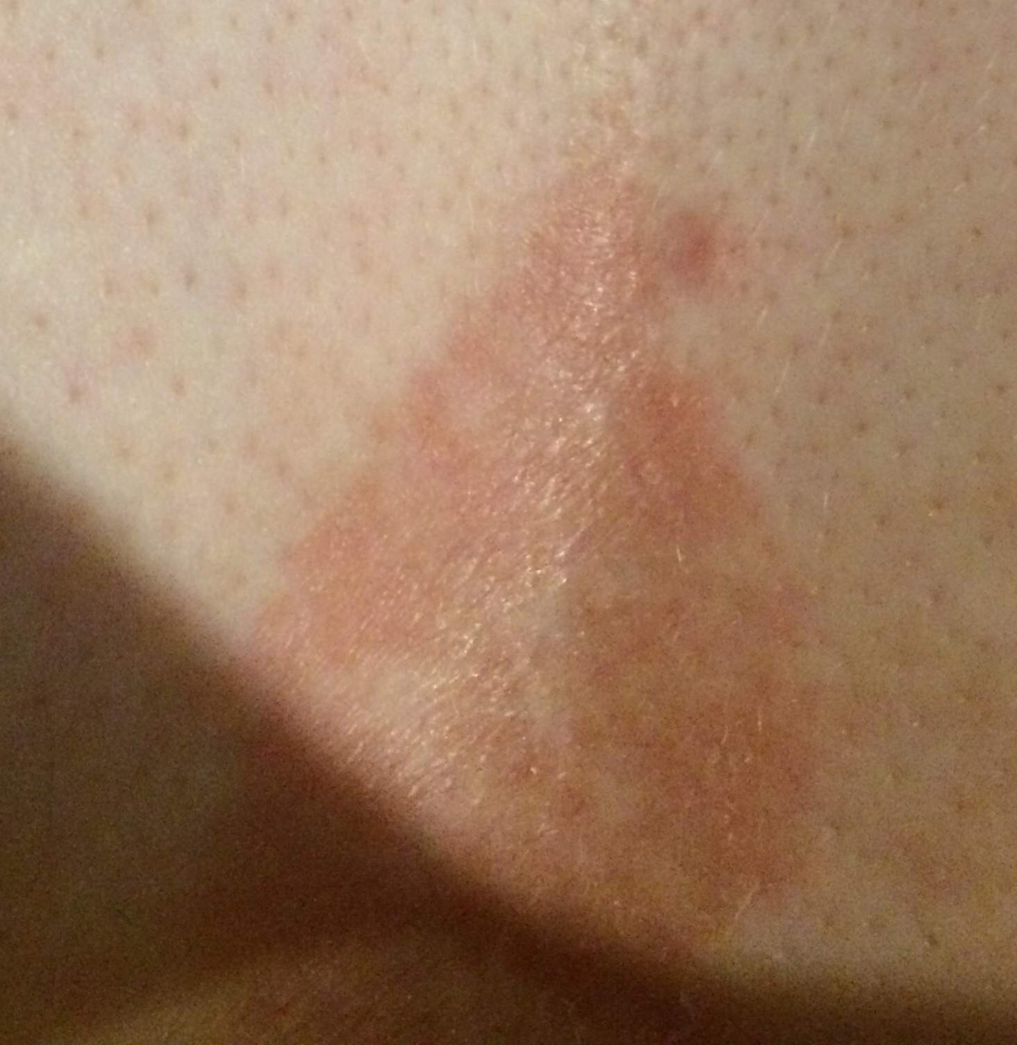 Was Ist Das Fur Ein Brauner Fleck Auf Meiner Haut Gesundheit Und Medizin Arzt Flecken Was Ist Das Fur Ein Brauner Fleck Auf Meiner Haut Gesundheit Und Medizin Arzt Flecken