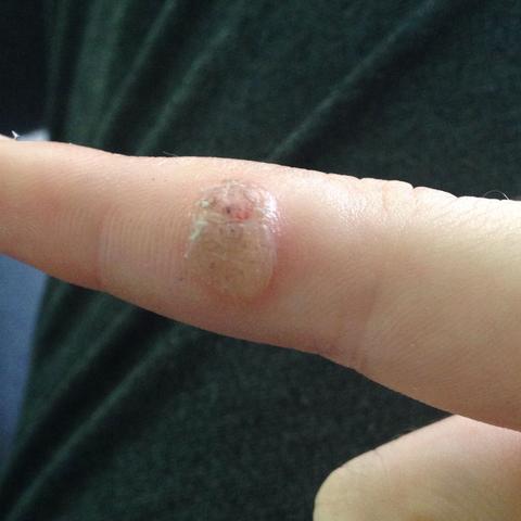 Was Ist Das Fur Ein Ding An Meinem Finger Ekelhaft