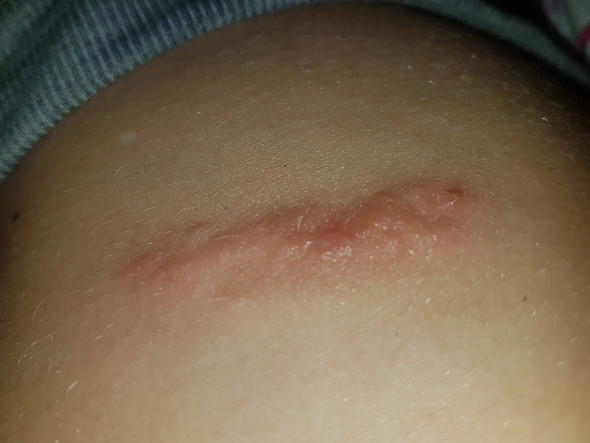 Was ist das für ein Ekzem, Ausschlag, Entzündung?? (Gesundheit