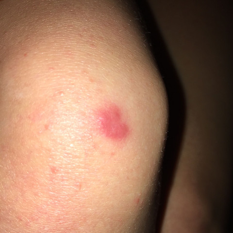 Was Ist Das Fur Ein Fleck Auf Den Knie Gesundheit Medizin Arzt Was Ist Das Fur Ein Fleck Auf Den Knie Gesundheit Medizin Arzt