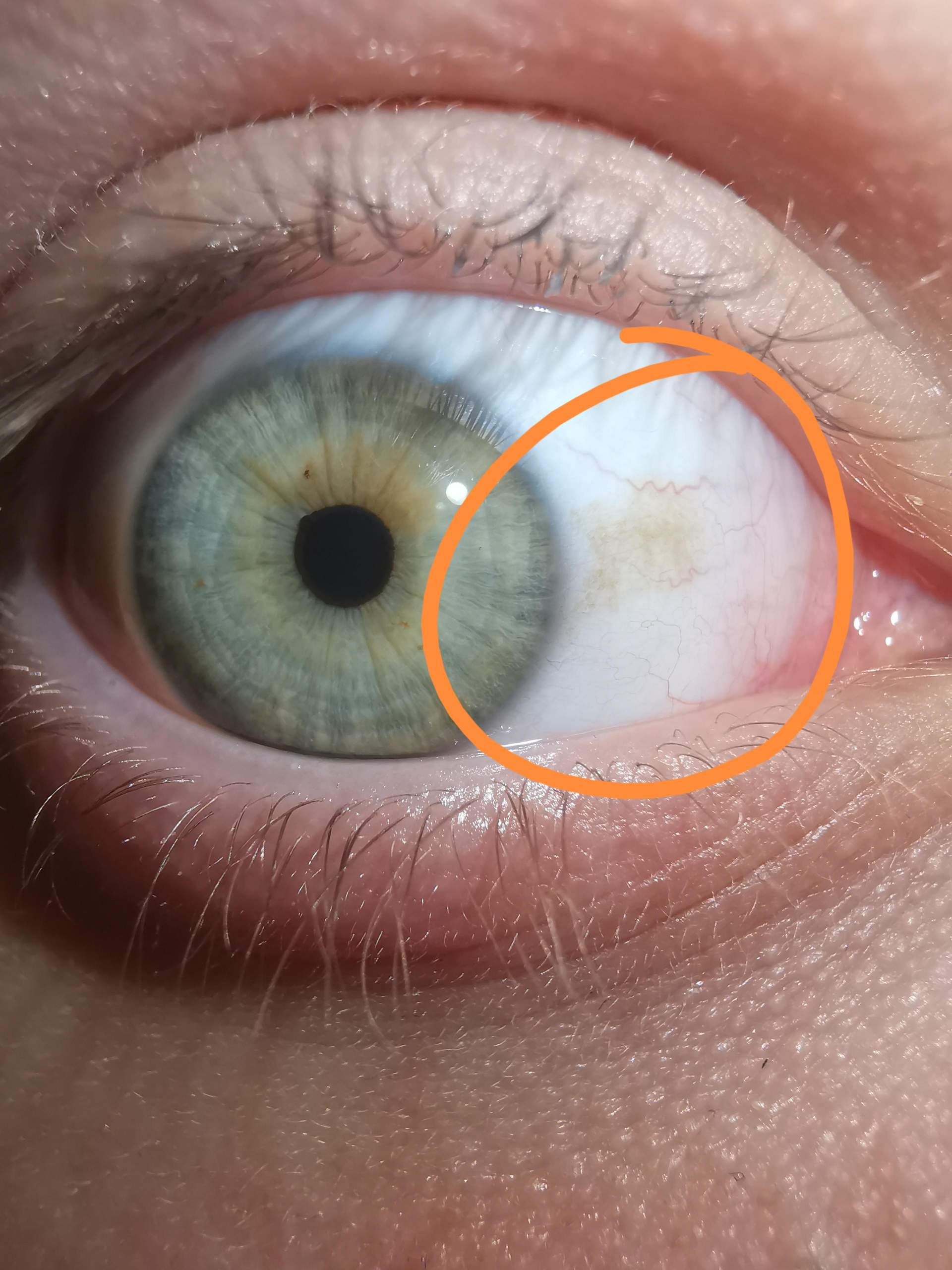 Was ist das für ein gelber fleck im Auge? (Augenarzt) Was ist das für ein gelber fleck im Auge? (Augenarzt)