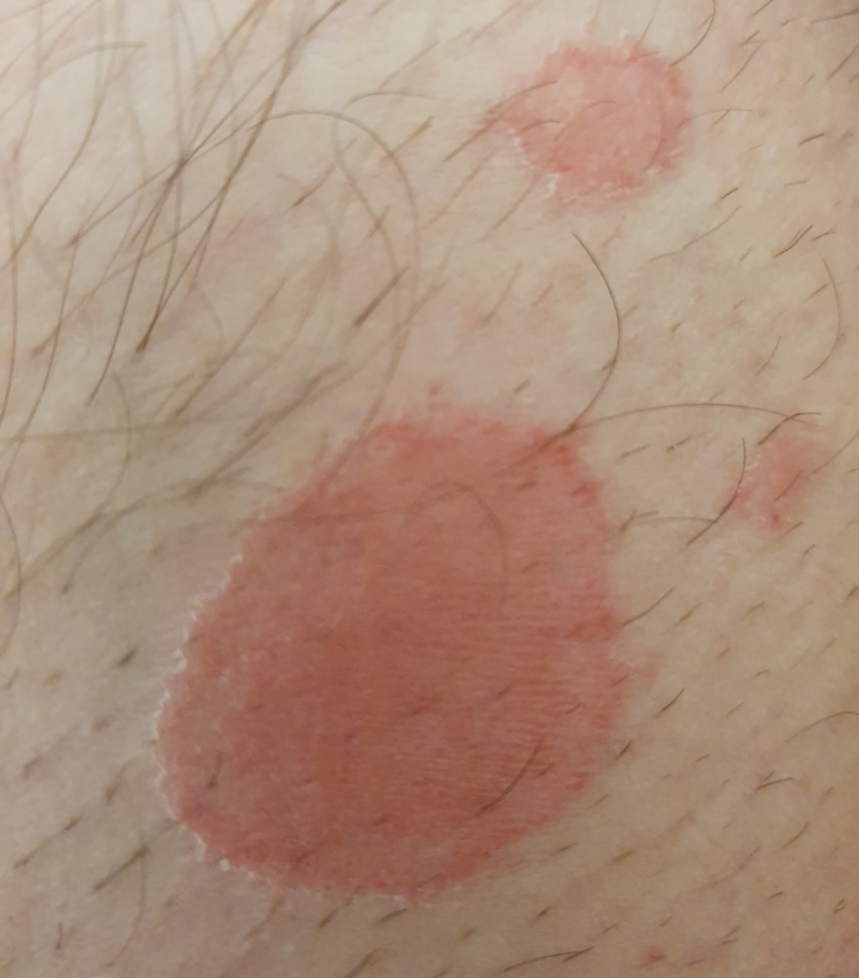 Was ist das für ein Hautausschlag auf meinem Oberschenkel? (Gesundheit, Medizin, Arzt)