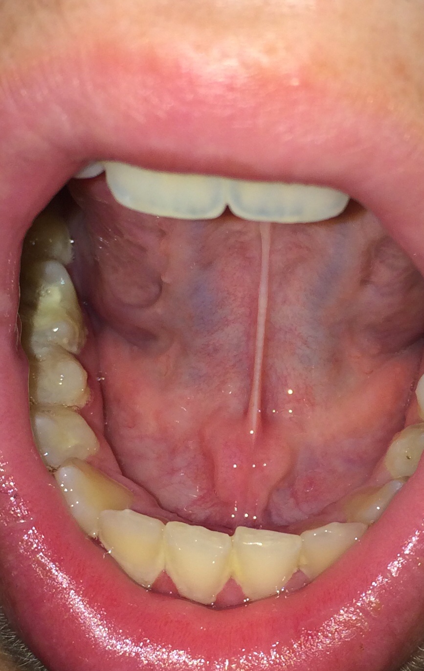 Was ist das für ein hubbel bzw Teil unter meiner Zunge (Mund) Was ist das für ein hubbel bzw Teil unter meiner Zunge (Mund)