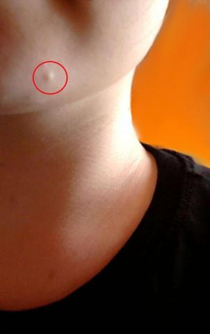 Was Ist Das Fur Ein Knubbel In Meinem Gesicht Haut Pickel Warzen Was Ist Das Fur Ein Knubbel In Meinem Gesicht Haut Pickel Warzen