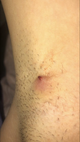 Was Ist Das Fur Ein Knubbel Unter Der Achsel Gesundheit Und Medizin Korper Frauenarzt Was Ist Das Fur Ein Knubbel Unter Der Achsel Gesundheit Und Medizin Korper Frauenarzt