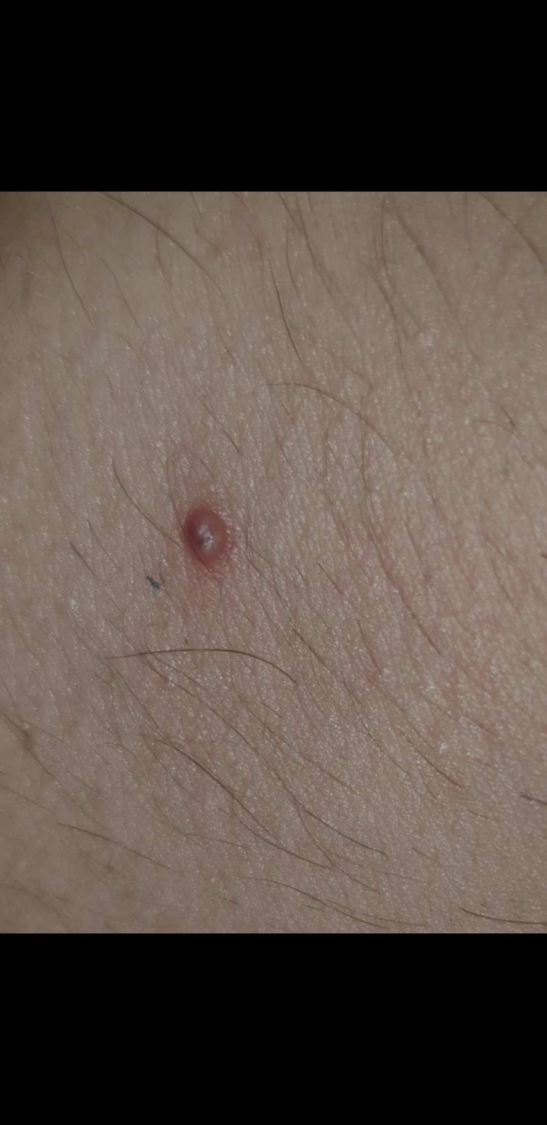 Was Ist Das Fur Ein Komischer Pickel Auf Meiner Brust Siehe Fotos Gesundheit Und Medizin Gesundheit Krankheit Was Ist Das Fur Ein Komischer Pickel Auf Meiner Brust Siehe Fotos Gesundheit Und Medizin Gesundheit Krankheit