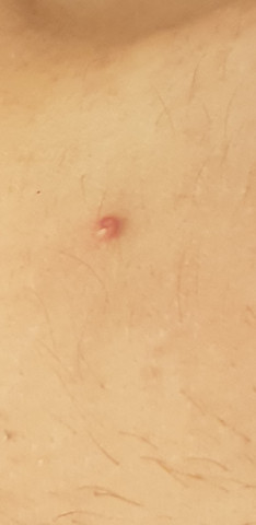 Was Ist Das Fur Ein Komischer Pickel Auf Meiner Brust Siehe Fotos Gesundheit Und Medizin Gesundheit Krankheit Was Ist Das Fur Ein Komischer Pickel Auf Meiner Brust Siehe Fotos Gesundheit Und Medizin Gesundheit Krankheit