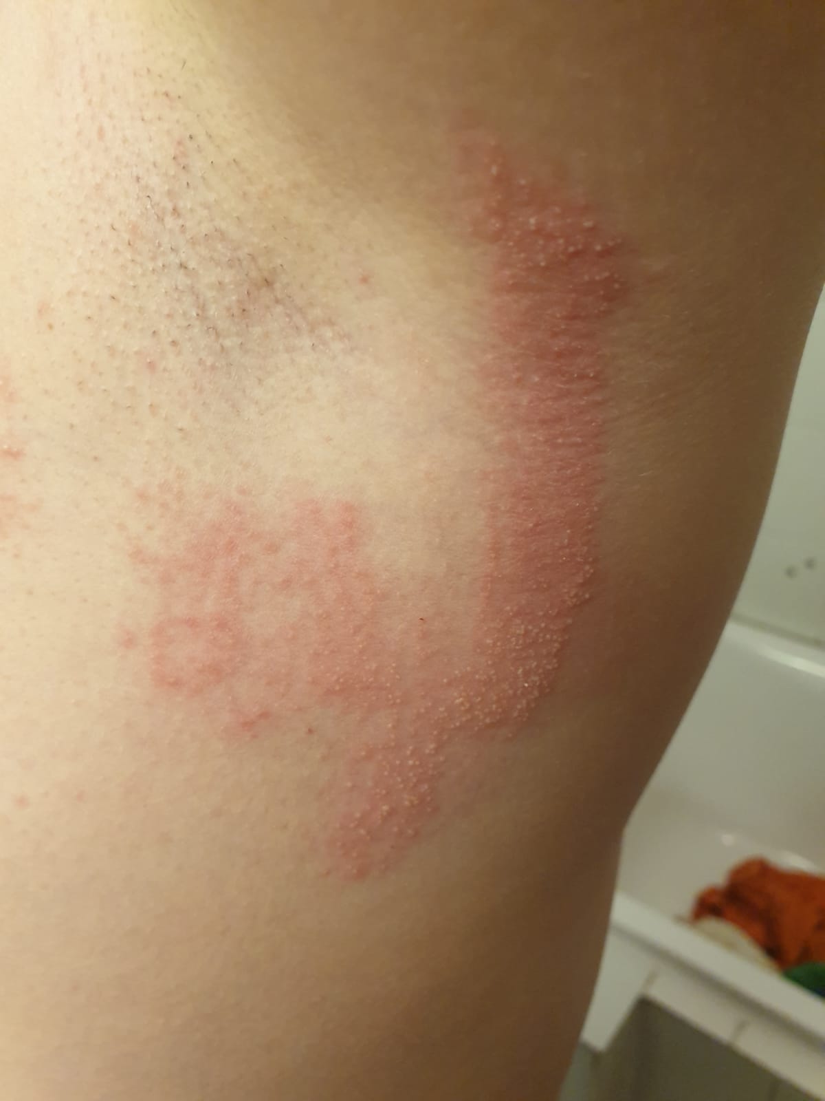 Was ist das für ein komischer schmerzhafter Ausschlag? (Gesundheit und