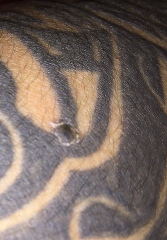 1ui - (Gesundheit, Tattoo)