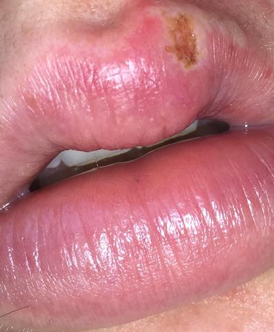 Was Ist Das Fur Ein Lippen Herpes Siehe Bild Medizin Teebaumol Lippenherpes Was Ist Das Fur Ein Lippen Herpes Siehe Bild Medizin Teebaumol Lippenherpes