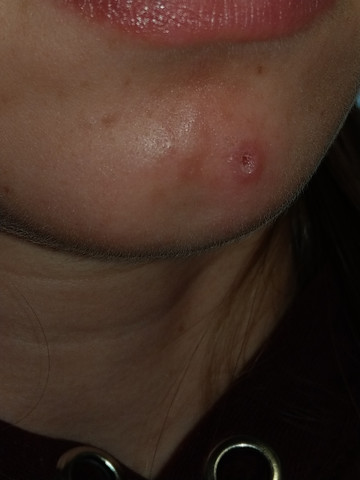 Was Ist Das Fur Ein Loch Seit 5 Wochen In Meinem Gesicht Gesundheit Und Medizin Haut Pickel Was Ist Das Fur Ein Loch Seit 5 Wochen In Meinem Gesicht Gesundheit Und Medizin Haut Pickel