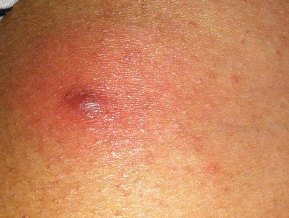 Was Ist Das Fur Ein Pickel Am Po Haut Was Ist Das Fur Ein Pickel Am Po Haut