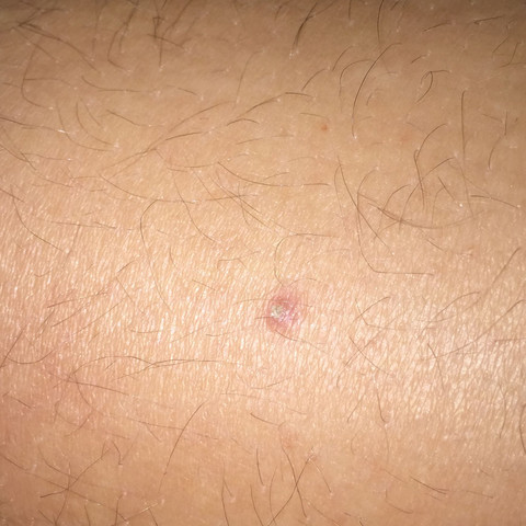 Was Ist Das Fur Ein Pickel An Meinem Bein Haut Was Ist Das Fur Ein Pickel An Meinem Bein Haut