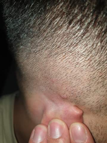 pickel auf meinem kopf