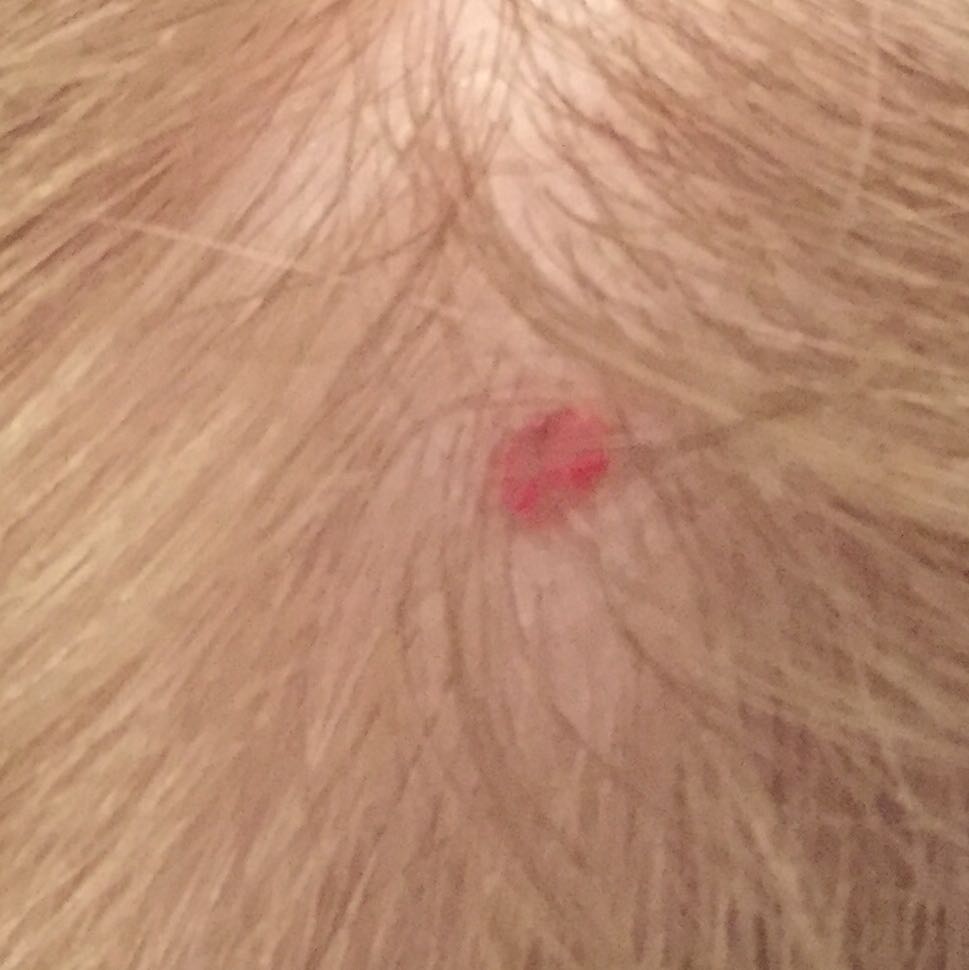 Was ist das für ein Pickel auf meiner Kopfhaut? (Haare, Medizin, Körper)