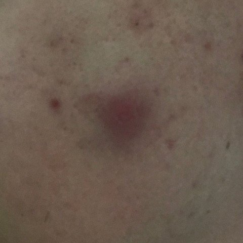 Was Ist Das Fur Ein Pickel Im Gesicht Gesundheit Und Medizin Schmerzen Akne Was Ist Das Fur Ein Pickel Im Gesicht Gesundheit Und Medizin Schmerzen Akne