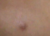 Was Ist Das Fur Ein Pickel Und Wie Kriege Ich Ihn Weg Beauty Haut Akne