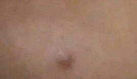 Was Ist Das Fur Ein Pickel Und Wie Kriege Ich Ihn Weg Beauty Haut Akne