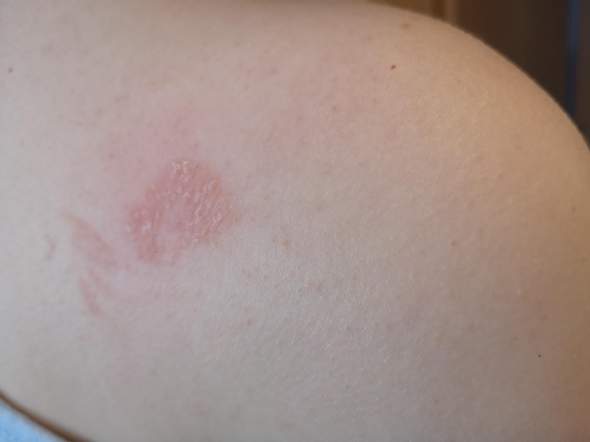 Was ist das für ein roter fleck an meiner Schter? (Gesundheit, Haut) Was ist das für ein roter fleck an meiner Schter? (Gesundheit, Haut)