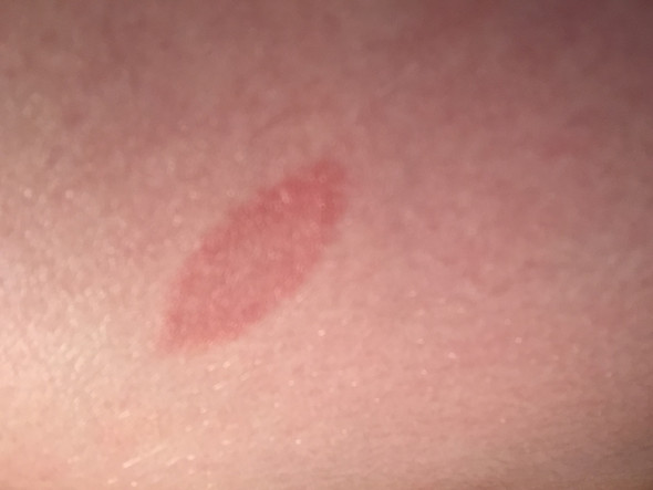 Was Ist Das Fur Ein Roter Fleck Auf Meiner Haut Was Ist Das Fur Ein Roter Fleck Auf Meiner Haut