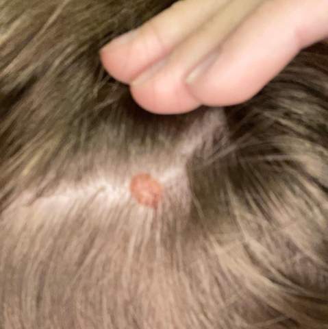 Was Ist Das Fur Ein Roter Fleck Auf Meiner Kopfhaut Gesundheit Und Medizin Haare Flecken
