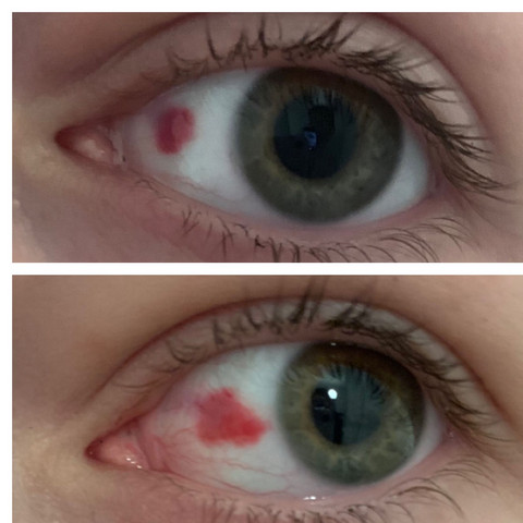 Was Ist Das Fur Ein Roter Fleck In Meinem Auge Gesundheit Und Medizin Augen Pupille Was Ist Das Fur Ein Roter Fleck In Meinem Auge Gesundheit Und Medizin Augen Pupille