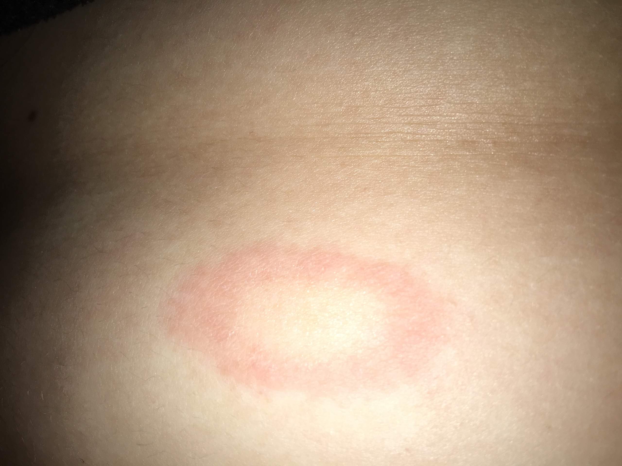 roter kreis bauch rote krankheit kreise meinen korper