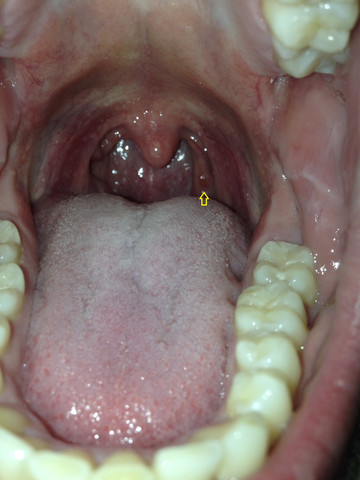 Was Ist Das Fur Ein Roter Punkt Im Rachen Medizin Arzt Hals Was Ist Das Fur Ein Roter Punkt Im Rachen Medizin Arzt Hals