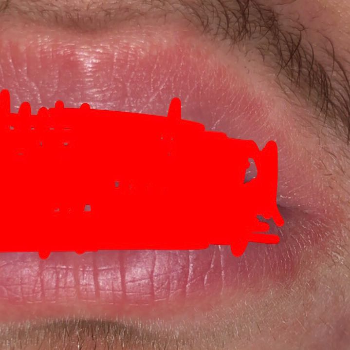 Was ist das für ein roter Rand um meinen Lippen? (Gesundheit und