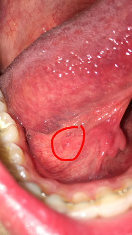 Was Ist Das Fur Ein Schwarzer Punkt Im Mundraum Arzt Mund Was Ist Das Fur Ein Schwarzer Punkt Im Mundraum Arzt Mund
